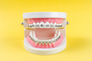 a closeup of model teeth with braces